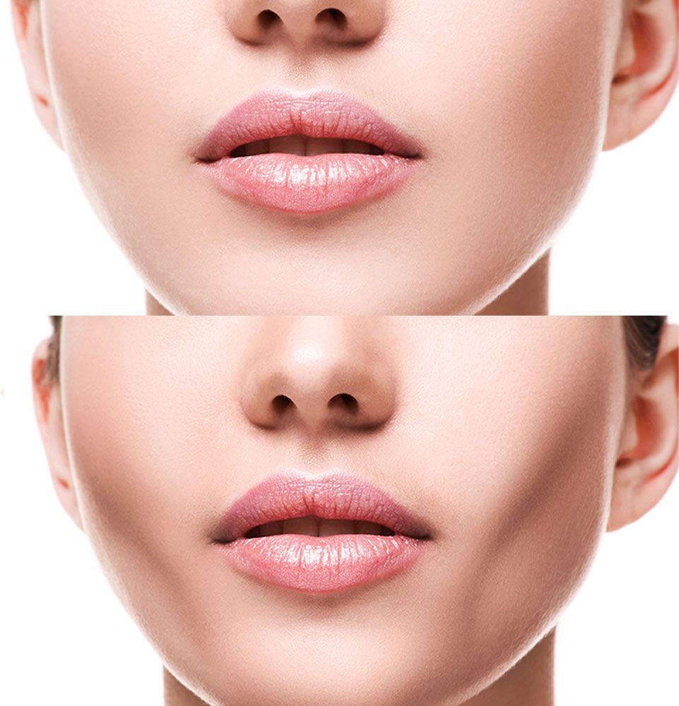 buccal fat removal