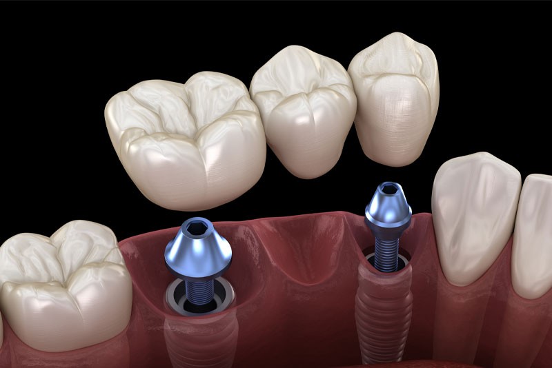 Implant Supported Bridge