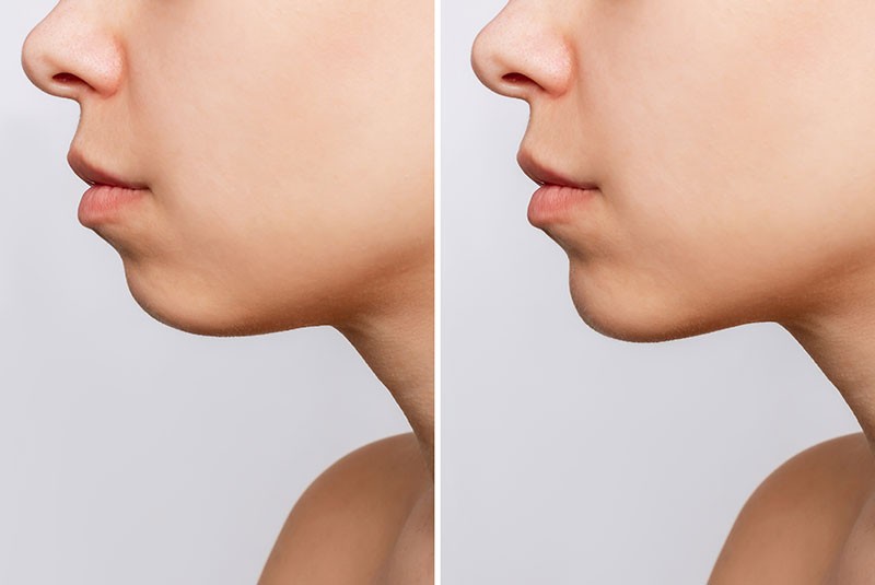 Chin Implants