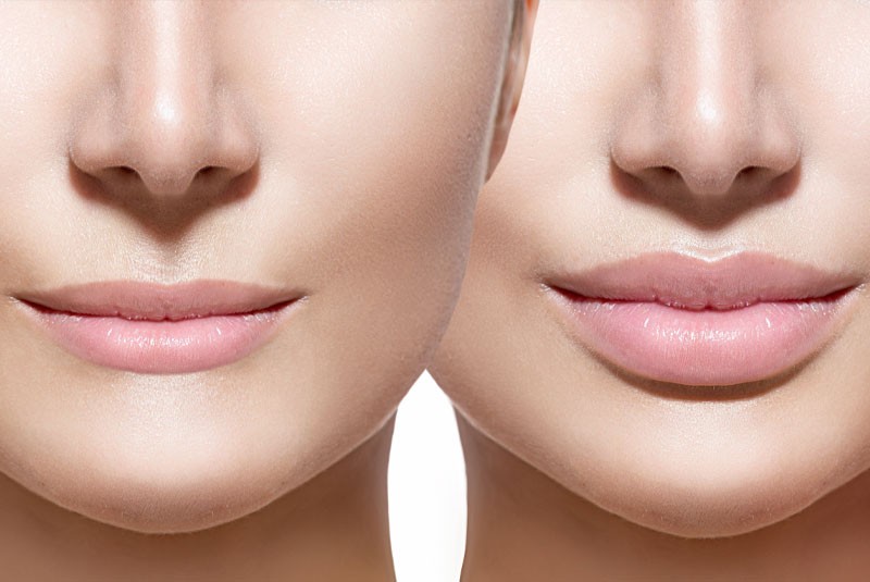Lip Implants