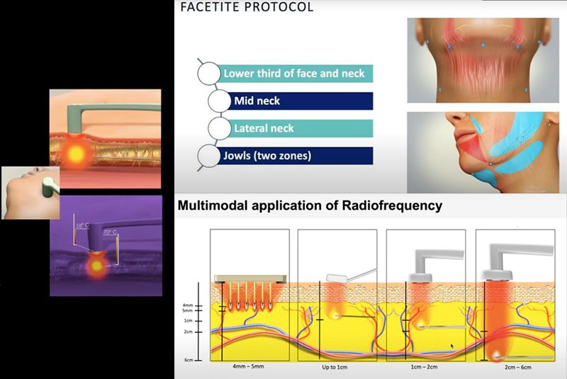 Radiofrequency