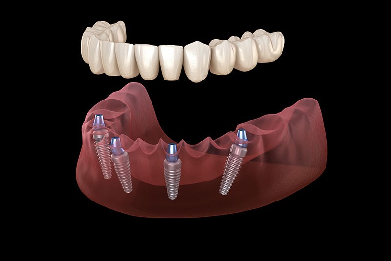 Full Mouth Dental Implants