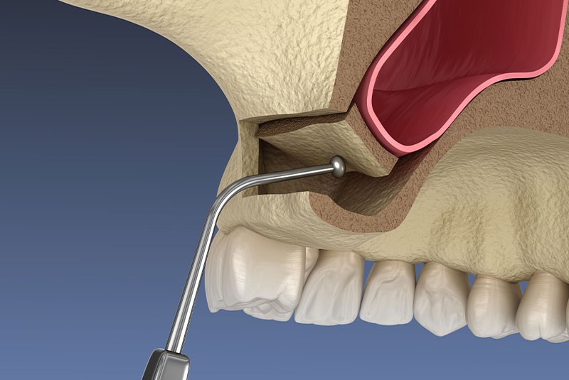 Lateral Sinus Lift