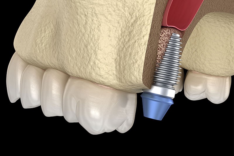 Benefits Of A Sinus Lift