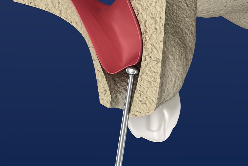Vertical SInus Lift