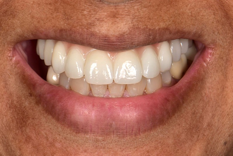 after dental implants