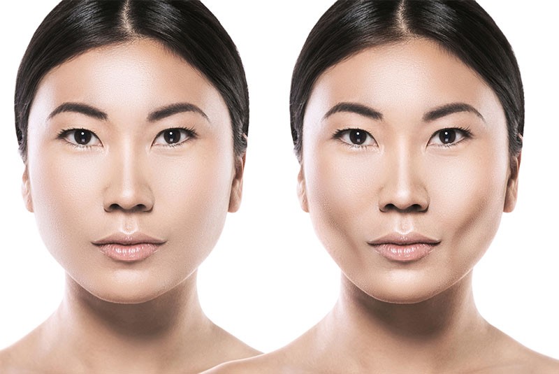 Buccal Fat Removal Surgery
