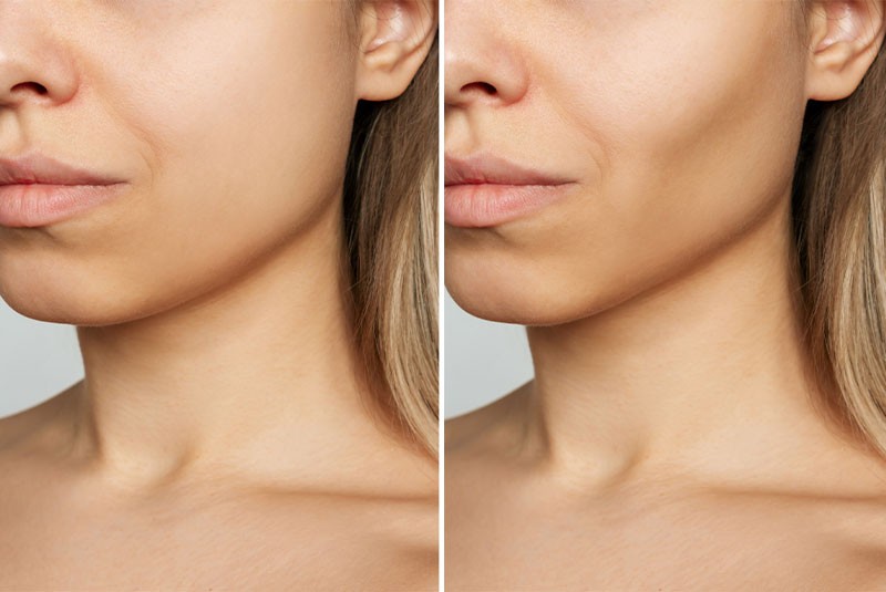 A Considered Approach To Buccal Fat Reduction