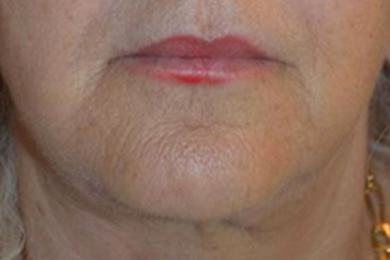 FaceTite lower face and neck 21 after