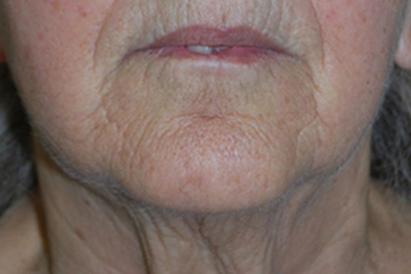 FaceTite lower face and neck 21 before