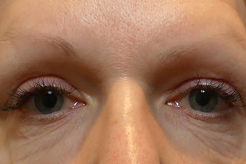 Morpheus 8 eye lid treatment before
