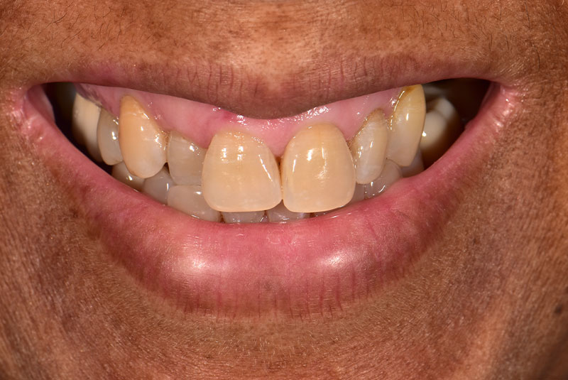 before dental implants